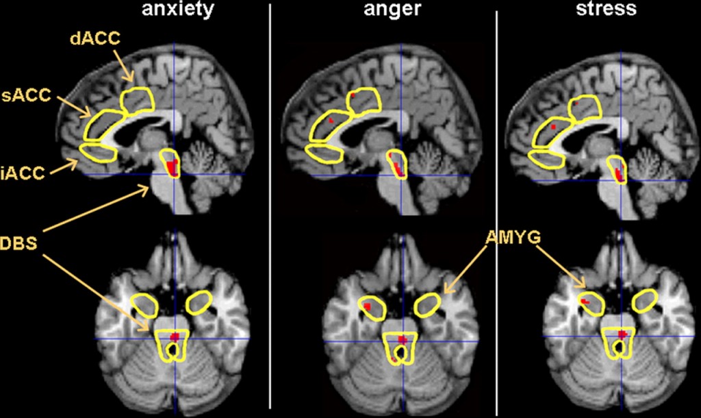 Anxious-brain