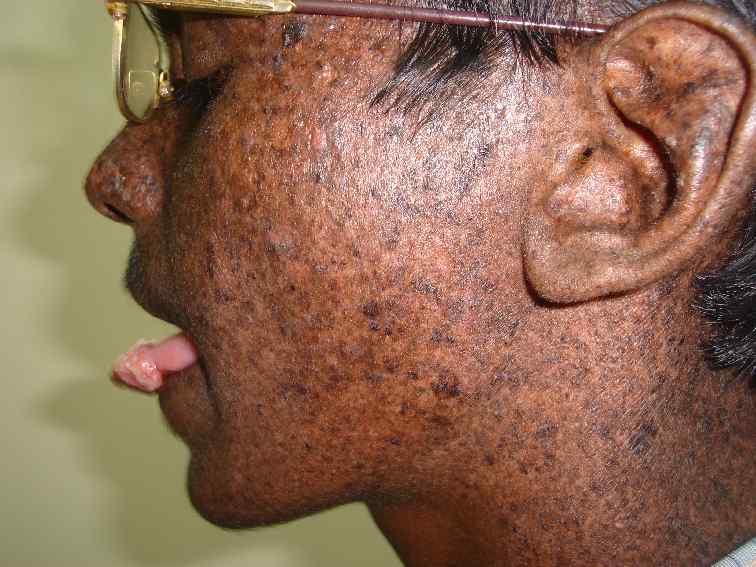 Xeroderma-Pigmentosum6