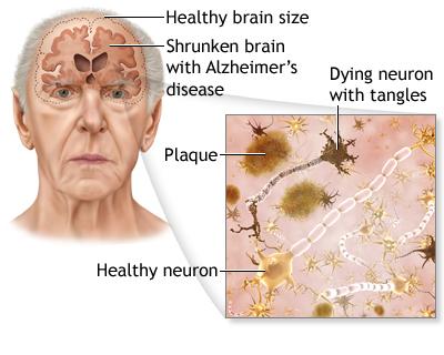 alzheimers_disease1.74165944_std