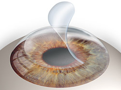 lasik-sg