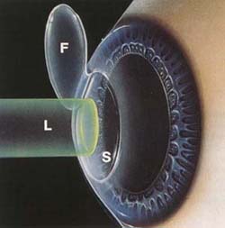 Is Lasik surgery safe?